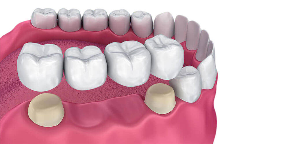 Dental Bridges Waterdown