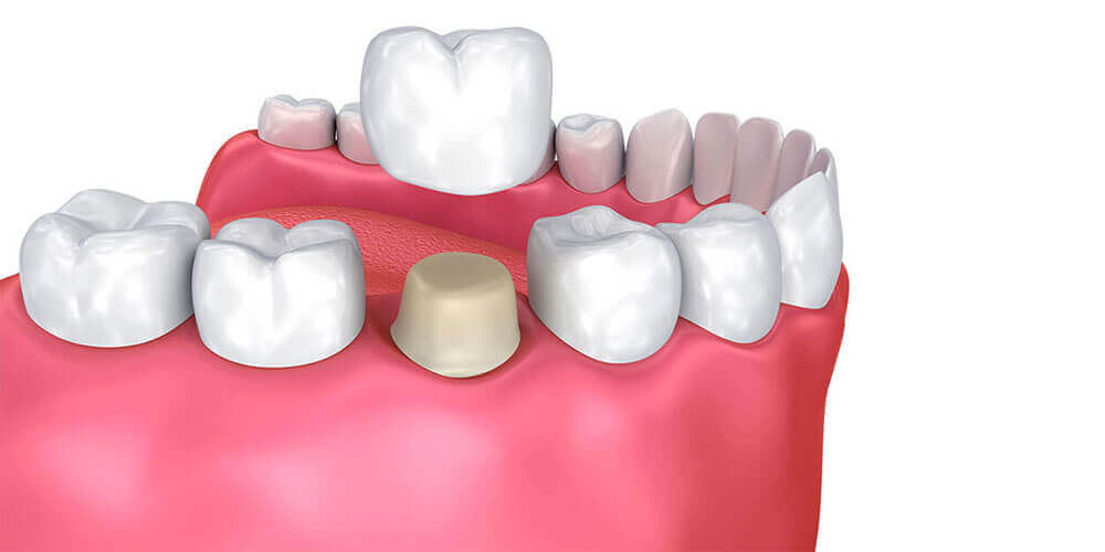 Dental Crowns Waterdown