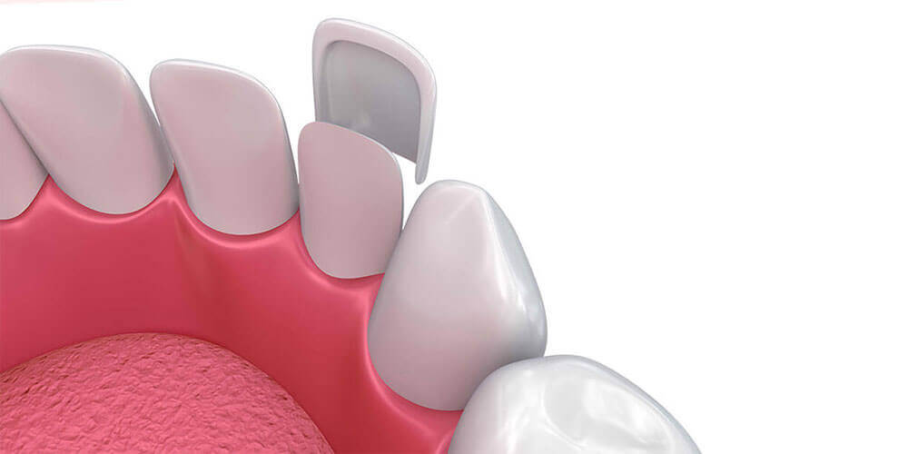 Dental Veneers Waterdown